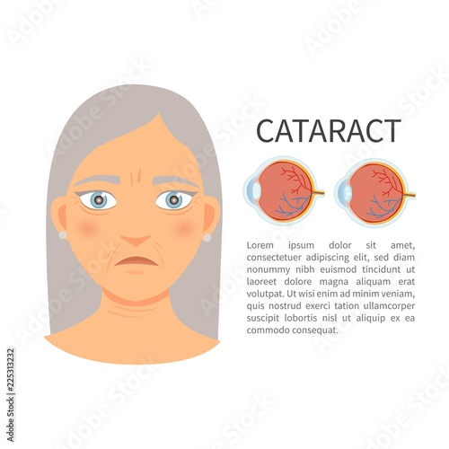 Illustration of an elderly woman with cataract. Anatomy of the eye.