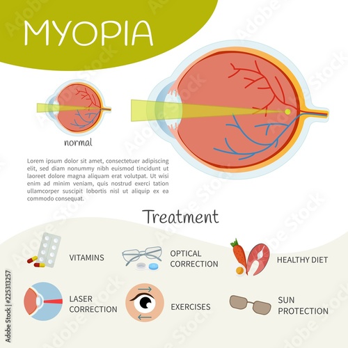 Infographics of myopia. Anatomy of the eye. Treatment of the disease.