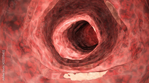 Foto 3d rendered medically accurate illustration of an inflamed colon