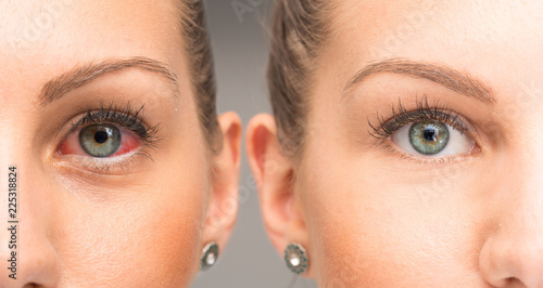 Fototapeta Naklejka Na Ścianę i Meble -  Red eye before and after eyewash