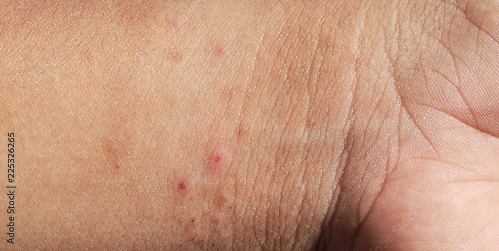 Fototapeta premium Rash on sensitive skin, skin problem with allergy rash, soft focus