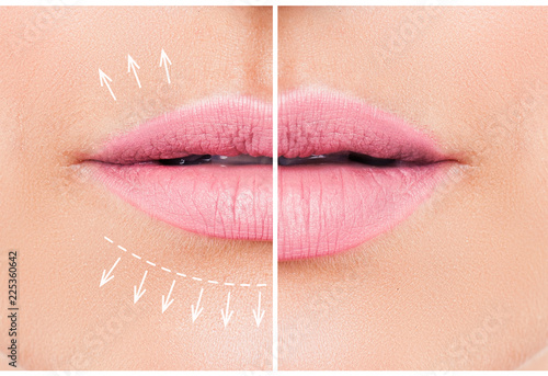 Obraz na plátně Beautiful pink lips before and after filler injection collagen to increase the volume of the lips