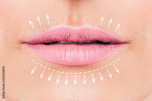Woman lips before filler injections. Fillers. Lip augmentation