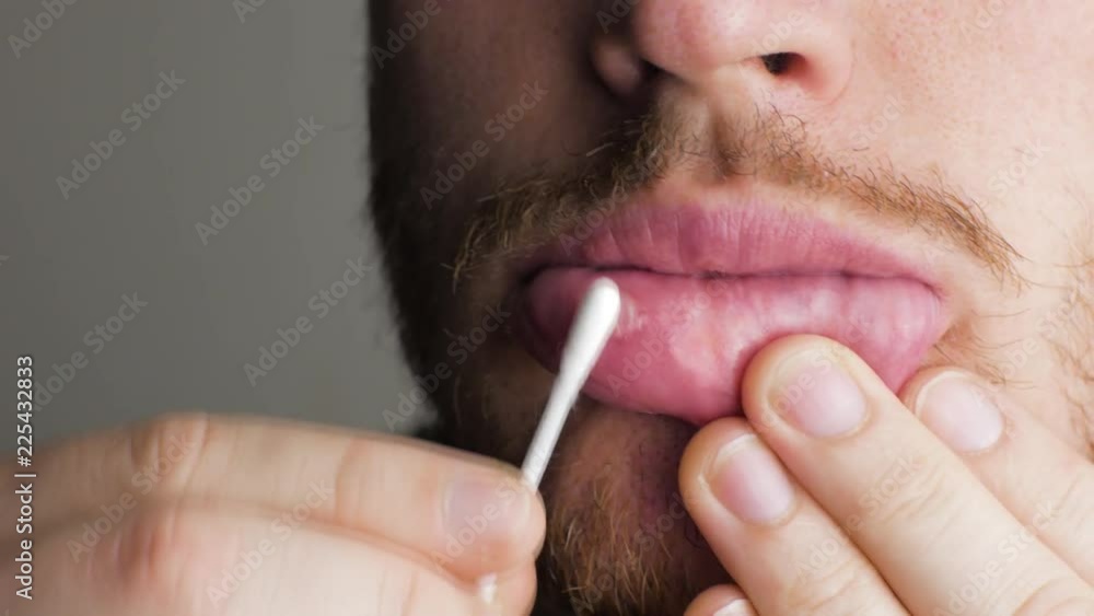 putting healing gel ointment on an aphtha oral inflammation on the gums