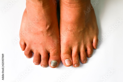 Close up of ingrown toenail is Inflamed fingernails
