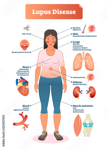Lupus disease vector illustration. Labeled diagram with sickness symptoms.