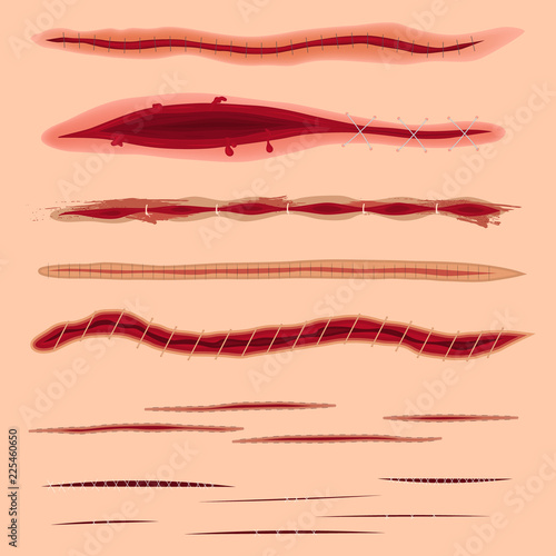 Realistic Detailed 3d Surgical Stitches Set. Vector