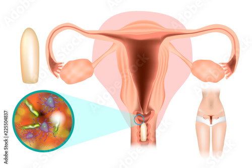 Treatment of female genital infections. Vaginal Suppositories. Vaginitis - inflammation of the vagina. Vaginal Dysbiosis. 