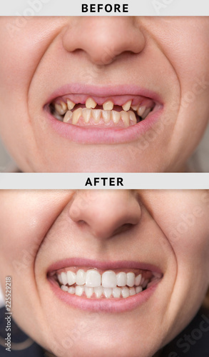 smile after and before dental crown installation process