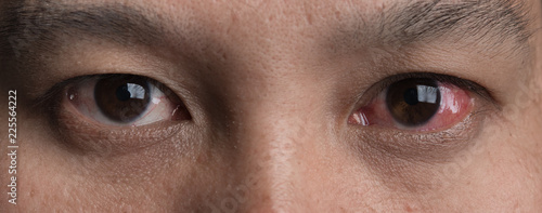 Human's red eye conjunctivitis