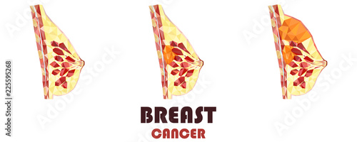 Women breast cancer cross section in low poly. Realistic 3d medical human organ. For medical education, for Clinics, Universities, Schools. Medical book, journal, research. Vector