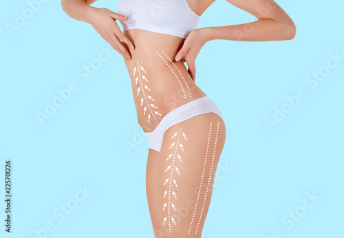 The cellulite removal plan. White markings on young woman body preparing for plastic surgery. Concept of slimming, liposuction, strand lifting