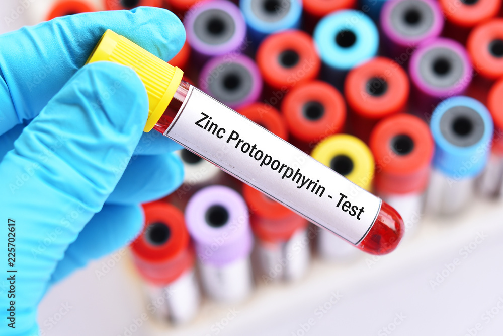 Obraz premium Blood sample tube for zinc protoporphyrin or ZPP test, diagnosis for anemia disease