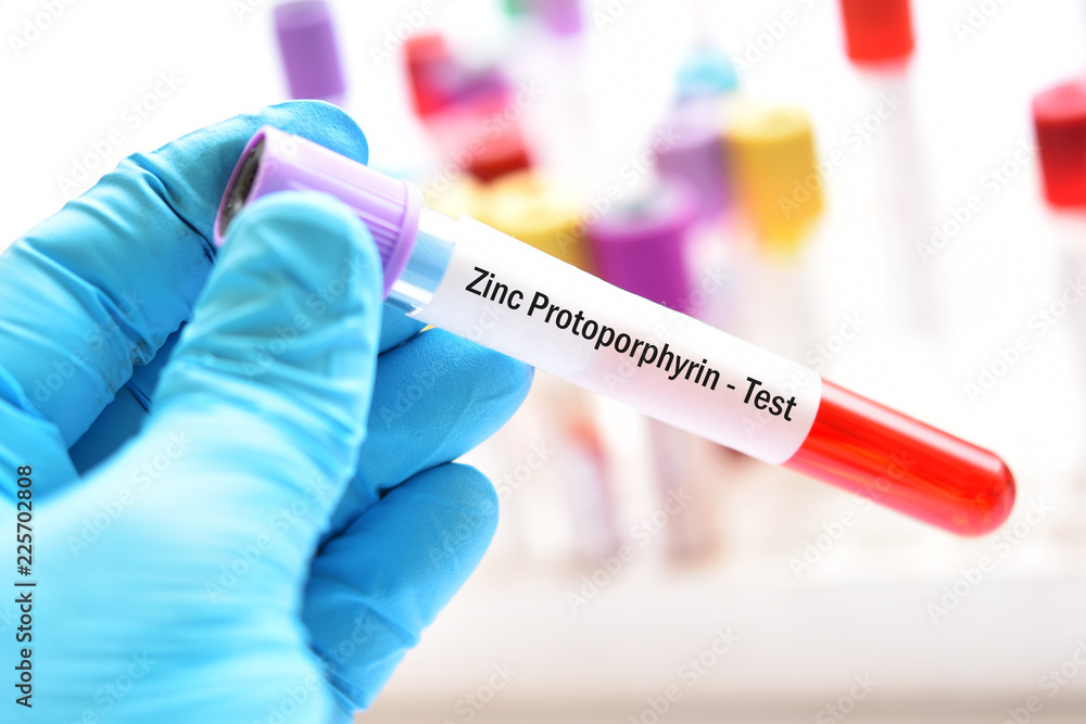 Obraz premium Blood sample tube for zinc protoporphyrin or ZPP test, diagnosis for anemia disease 