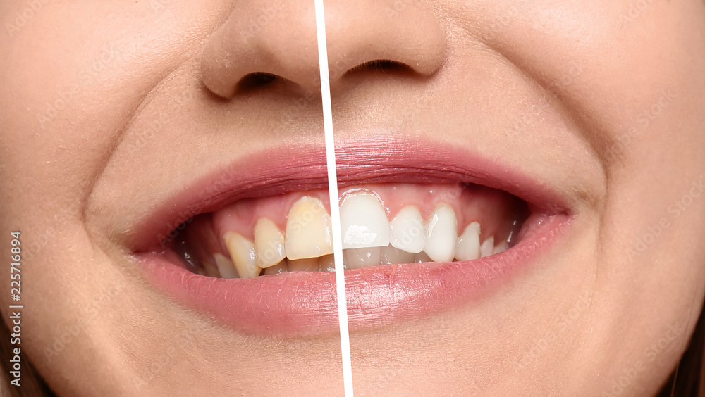 Obraz premium Smiling woman before and after teeth whitening procedure, closeup