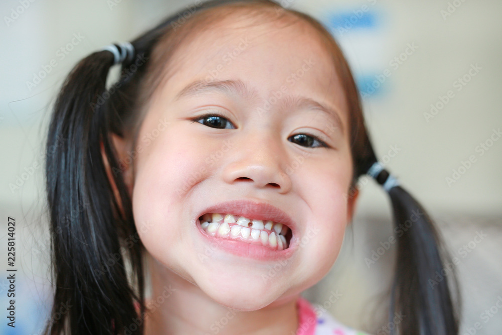 Face of little Asian child girl with a teeth broken and rotten. Face of little Asian child girl with a teeth broken and rotten.