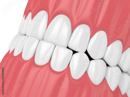 3d render of jaw malocclusion with underbite photo