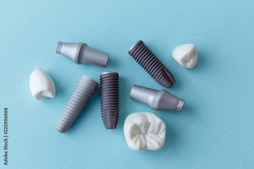 Fototapeta premium This model shows that teeth have been capped and the stainless pin in the gums. blue background