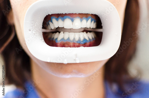 Obraz na płótnie Teeth whitening