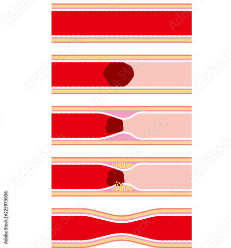 動脈硬化など血管疾患のイメージ