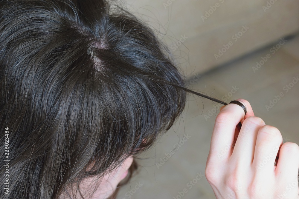 Fotografie Trichotillomania, human impulse behavioral problem,hair pulling disorder