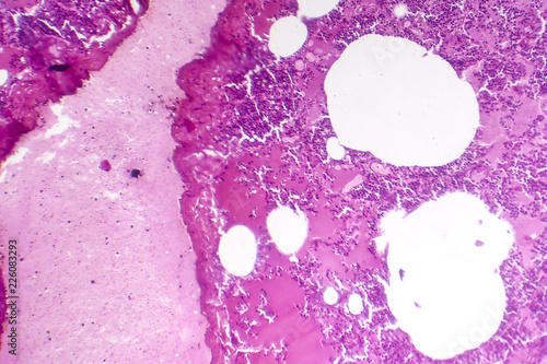 Lobar pneumonia, hemorrhagic edema period, light micrograph, photo under microscope photo
