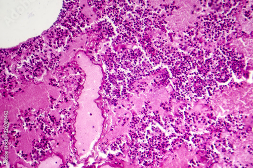 Lobar pneumonia, hemorrhagic edema period, light micrograph, photo under microscope photo