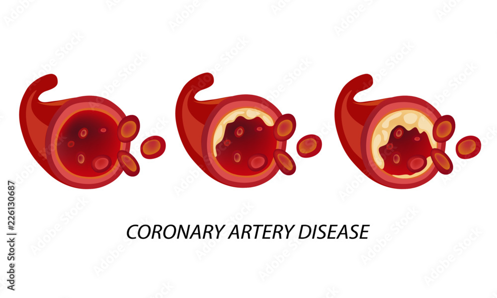 Coronary Artery Disease Is The Part Of Heart Disease It Happens When