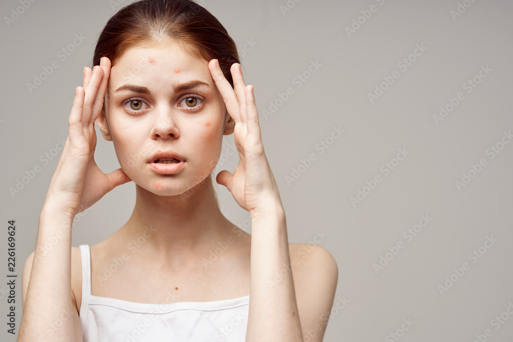 Fototapeta premium a young woman has acne