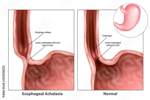 Esophageal achalasia, often called simple achalasia. Lower esophageal sphincter doesn’t relax. Esophageal achalasia, often called simple achalasia photo