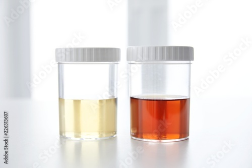 Blood in human urine in sample pot