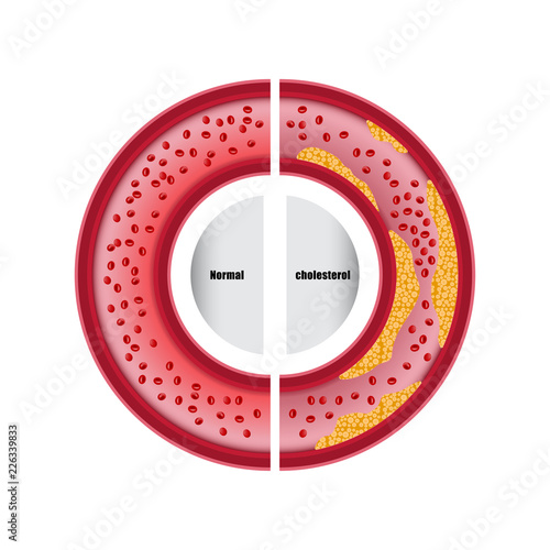 Comparison between normal blood vessel and cholesterol