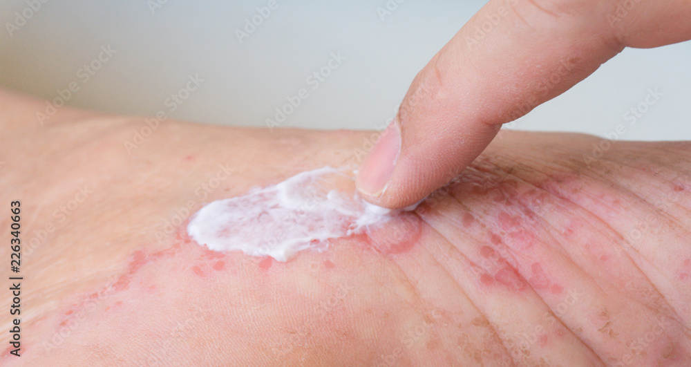 Applying topical steroid ointment to a contact dermatitis skin rash