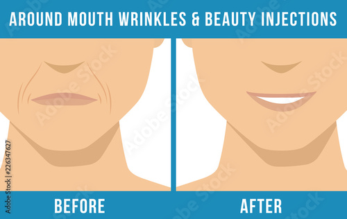 Man anti-aging skin care and men cosmetics. Different types of facial wrinkles. Man before and after Botox injection. Anti-aging procedure. Vector