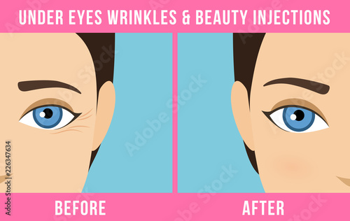Women anti-aging skin care. Different types of facial wrinkles. Woman before and after Botox injection. Anti-aging procedure. Vector
