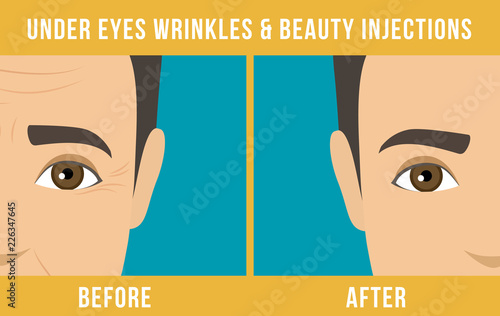Man anti-aging skin care and men cosmetics. Different types of facial wrinkles. Man before and after Botox injection. Anti-aging procedure. Vector