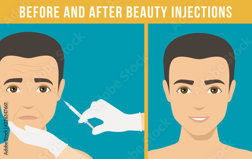 Man anti-aging skin care and men cosmetics. Different types of facial wrinkles. Man before and after Botox injection. Anti-aging procedure. Vector
