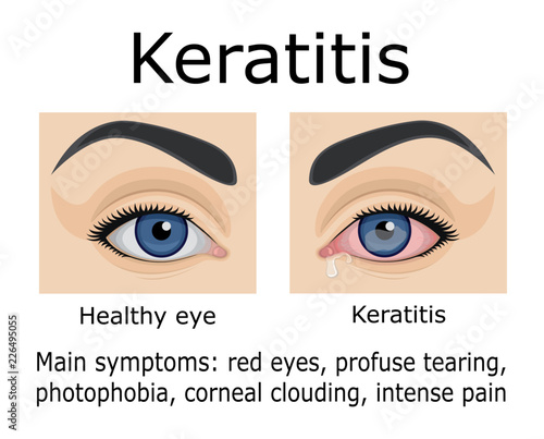 Illustration of Keratitis disease