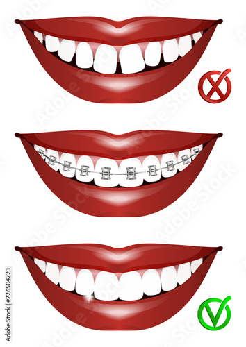 Set of smiles. Curved teeth, teeth in braces and even beautiful teeth. Illustration of orthodontic treatment. Vector illustration.