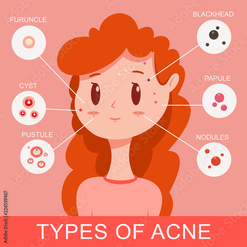 Types of acne infographics. Cute young girl with pimples. Vector cartoon flat medical concept illustration.