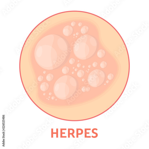 Herpes on the skin. Healthcare and dermatology