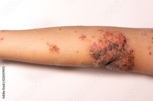 Impetigo on a child's arm