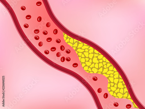 Cholesterol in blood vessel blocking flow of blood