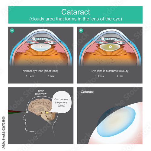 Cataract is a dense cloudy area that forms in the lens of the eye