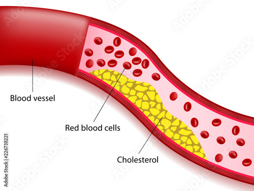 Accumulation of cholesterol in the arteries