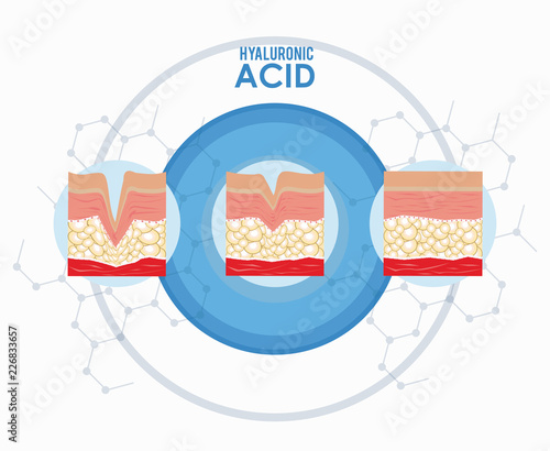 hyaluronic acid filler injection infographic