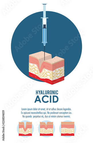 hyaluronic acid filler injection infographic