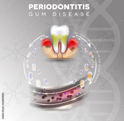 Periodontitis, inflammation of the gums bacteria can enter in to the blood stream and initiate complications in other parts of body, such as stroke, diabetes and heart disease