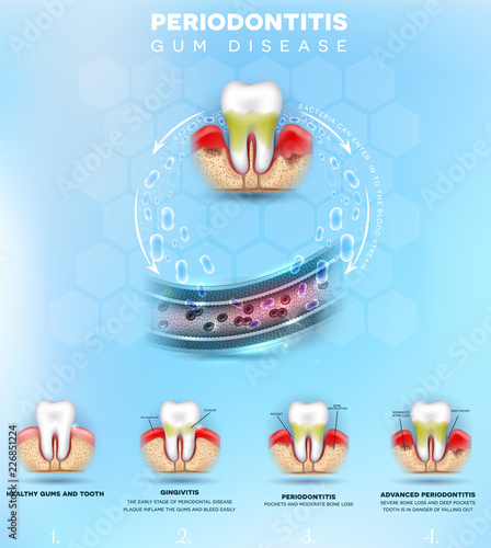 Periodontitis formation, inflammation of the gums bacteria can enter in to the blood stream and initiate complications in other parts of body, such as stroke, diabetes and heart disease