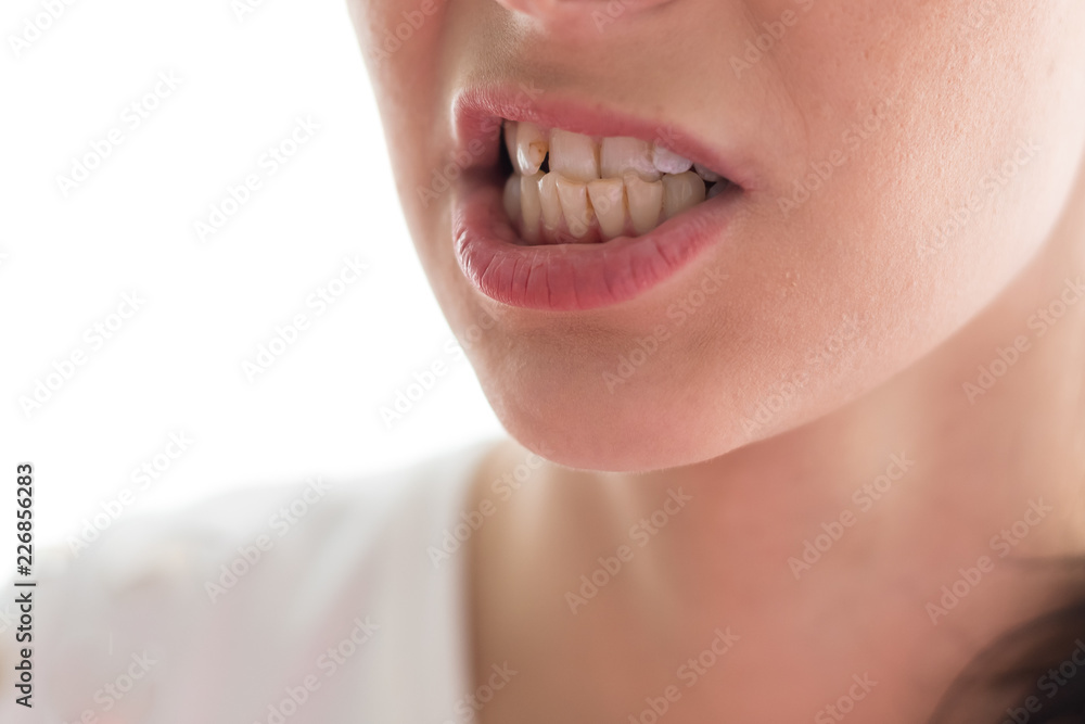 Obraz premium Problem teeth at the young girl. A curve row and the wrong bite an occasion to visit the dentist and the orthodontist